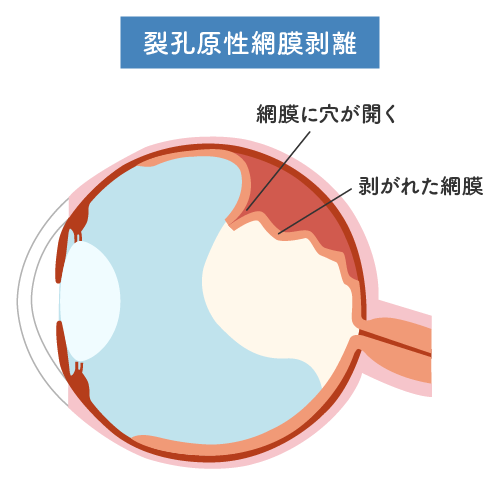 網膜裂孔・網膜剥離 | 診療のご案内 | もりや眼科 奈良市の白内障手術